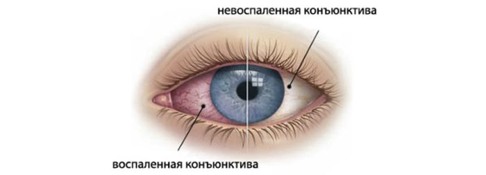 Болезнь глаза конъюнктивит