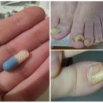 Таблетки Орунгамин от грибка ногтей: инструкция по применению