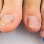 Застарелый грибок и деформация ногтей на ногах: причины и лечение