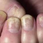 Как связаны психосоматика и грибок ногтей?