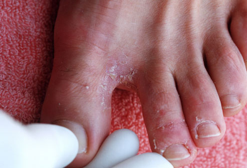 Трещины на пальцах ног причины и лечение