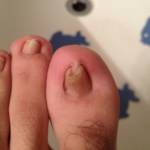 Застарелый грибок и деформация ногтей на ногах: причины и лечение