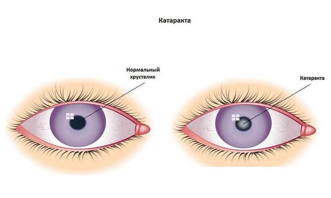 Помутнение хрусталика глаза - катаракта