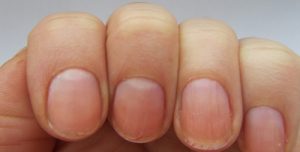 Фото, симптомы и лечение псориаза ногтей