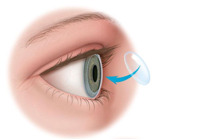Операция на роговице глаза