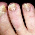 Может ли грибок ногтей перейти на кожу ног и рук?