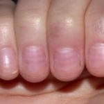 Причины и лечение белых полосок на ногтях рук