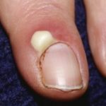 Грибок кандида на ногтях: фото, симптомы и лечение