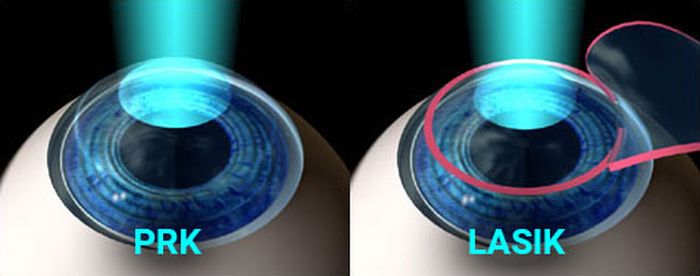 Виды операций на глазах