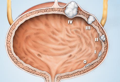 Папилломы мочевого пузыря - как распознать и вылечить болезнь