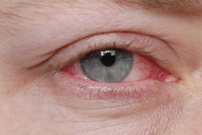 Конъюнктивит — воспалительное заболевание глаз