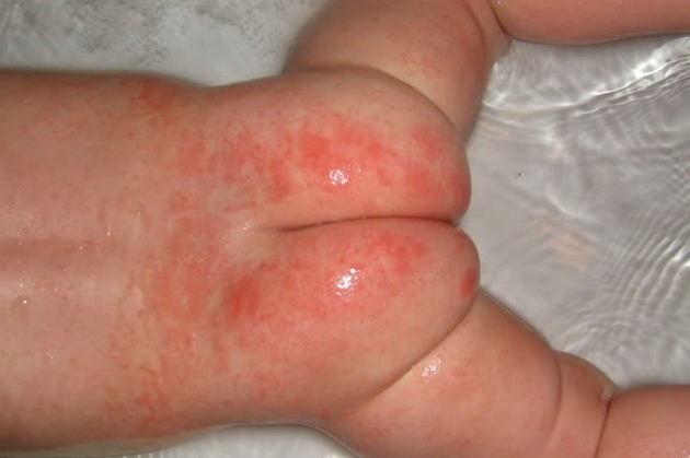 грибковый дерматит у ребенка