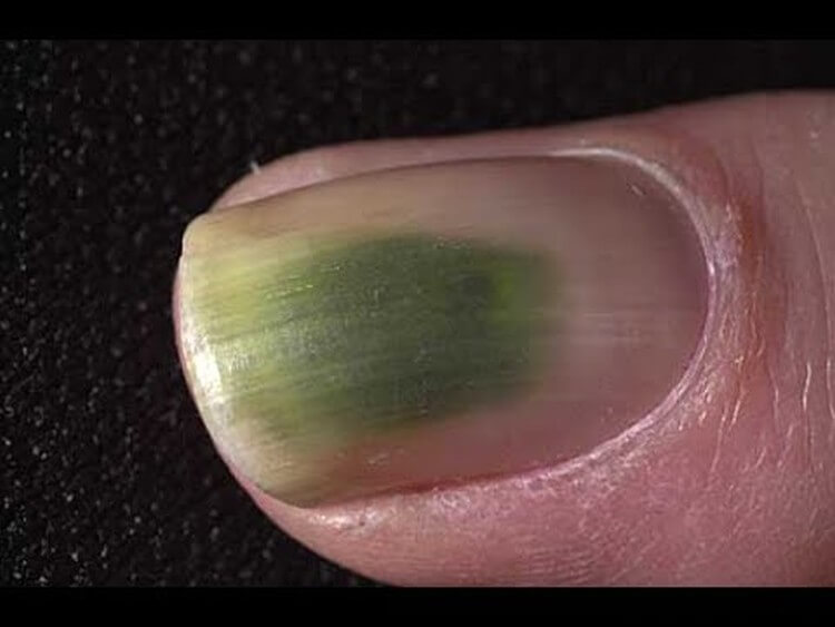 Плесень на ногтях причины появления и лечение