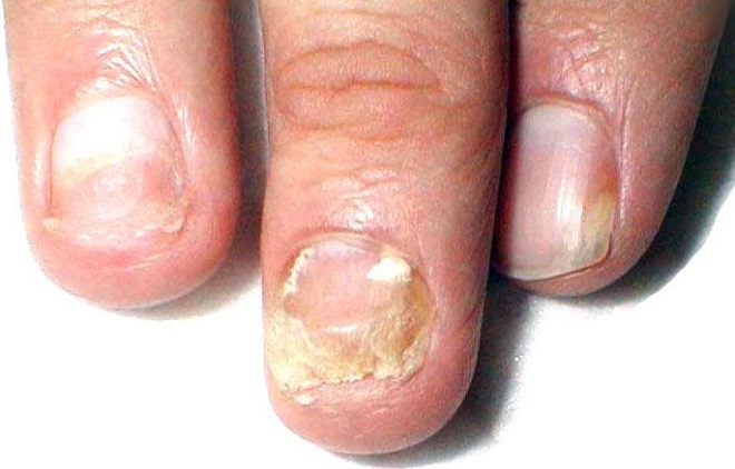 Дрожжевой грибок на ногтях