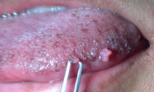 Подробно о способах лечения папиллом в полости рта