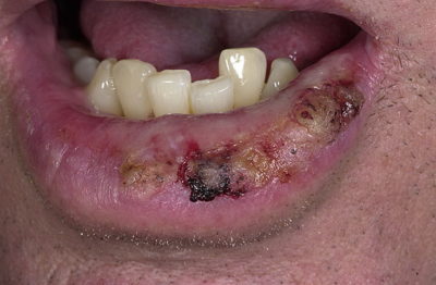 Причины появления бородавок на губе и способы их лечения