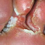 Почему трескается и чешется кожа между пальцами на ногах: причины и лечение