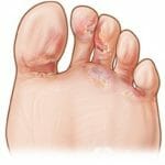Заболевания ногтей на ногах: фото и причины, лечение