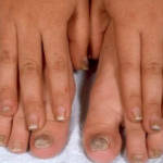 Неприятный запах под ногтями на ногах: причины и лечение