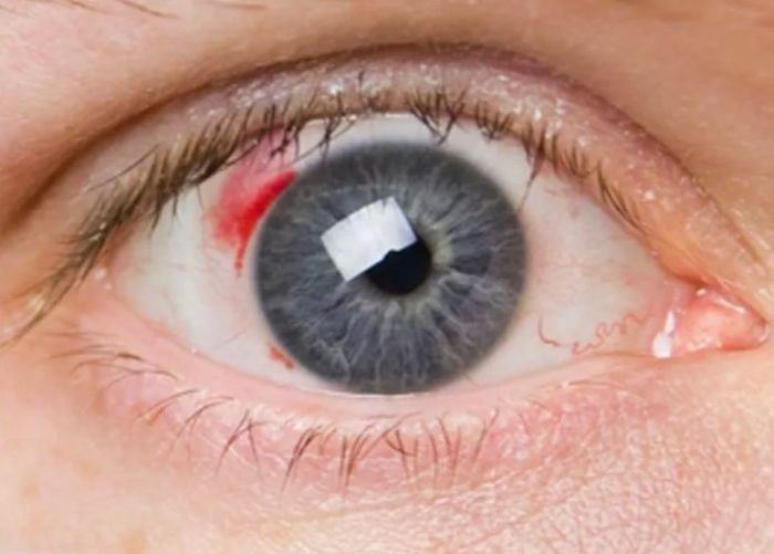 Диабетическая ретинопатия глаз