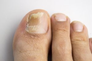 При образовании грибка ногтя на большом пальце ноги лечение какого рода применить