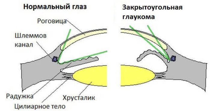 Схема закрытоугольной глаукомы
