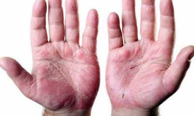 Симптомы и лечение псориаза пальцев рук