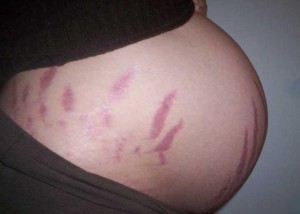 Папилломы на шее при беременности причины