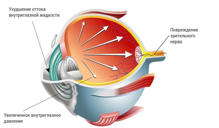 Операция по удалению глаукомы