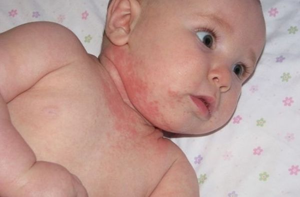 симптомы аллергической сыпи у детей