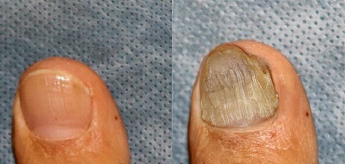 Можно или нет лечить грибок ногтей керосином