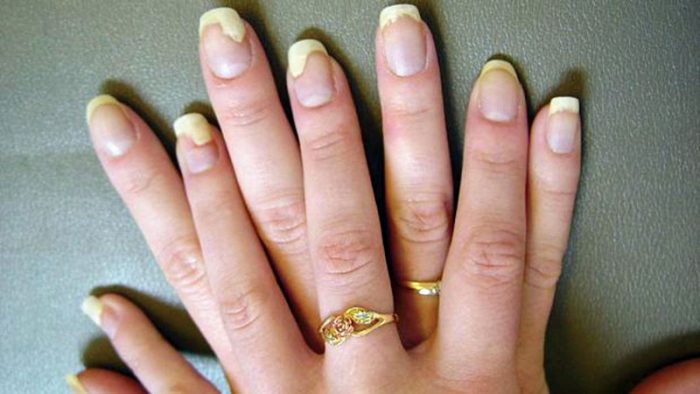 Методы лечения грибка ногтей при беременности