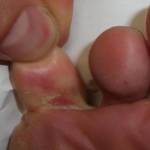 Между пальцами ног шелушение, зуд, трещины у взрослого: чем лечить?