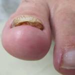 Заболевания стопы ног: фото грибка стопы и ногтей, лишая