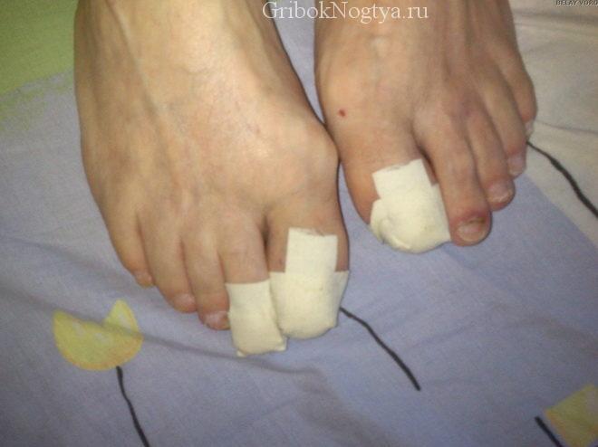 Лечение грибка ногтей на ногах и руках