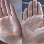 У ребенка трескается кожа на пальцах рук: причины и лечение