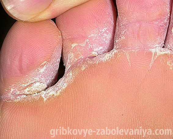 Как использовать Ламизил для лечения грибка ногтей