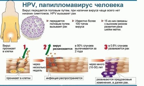 ВПЧ 33 типа предвестник дисплазии шейки матки и онкопатологий