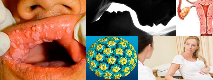 ВПЧ типы вируса и их опасность