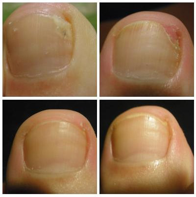 Противогрибковое средство Serrix B.V. Набор Микозан для удаления грибкового поражения с ногтевой пластины - отзыв