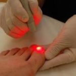 Удаление вросшего ногтя на ноге хирургическим путем и лазерным методом