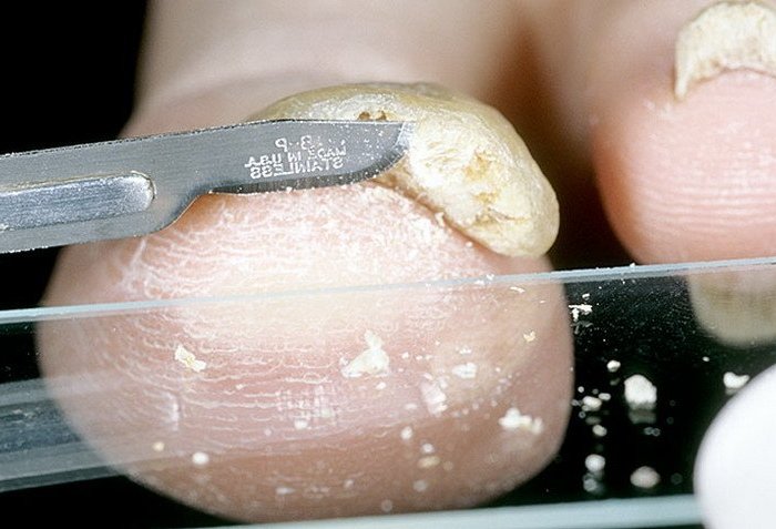 Взятие соскоба с кожи и ногтей. Как правильно сдать анализ