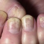 Как выглядит грибок ногтей на руках: симптомы и лечение