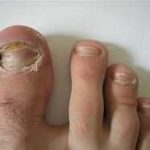 Чем лечить грибок ногтей на ногах в запущенной стадии?