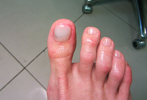Лечебные свойства лака от микоза ногтей способствующие избавлению от грибка ногтей на руках и ногах