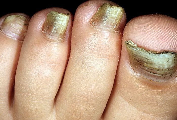 Средство от грибка ногтей ногтимицин