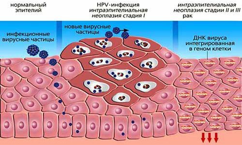 Признаки ВПЧ 35 типа у женщин что это за вирус и как его лечить