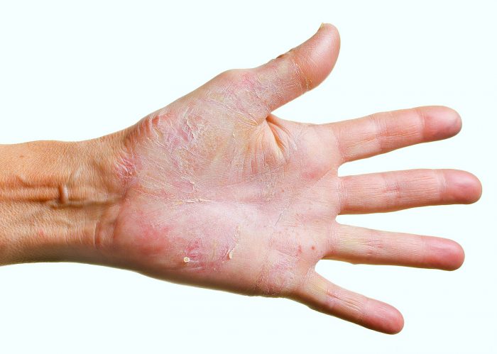 Эффективное лечение грибка рук народными средствами