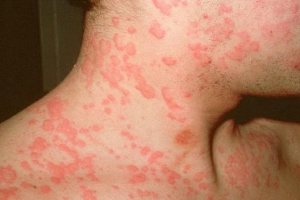 пятна на коже при аллергии