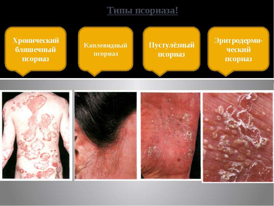 Как не спутать псориаз с другими заболеваниями